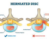 herniated disc