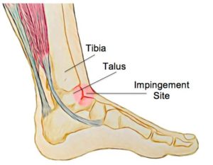 Focus On Anterior Ankle Impingement