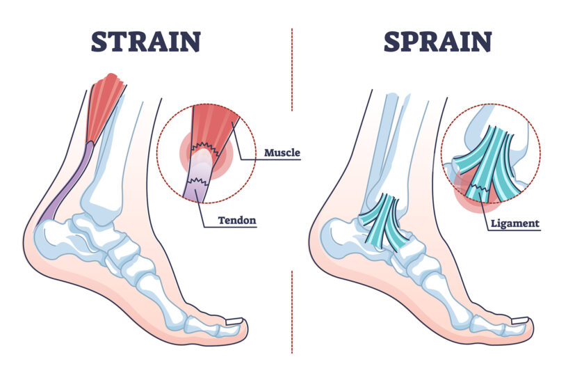 Sprains vs Strains