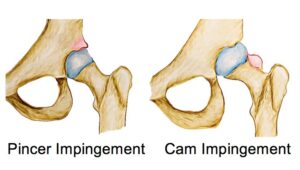 FemoroAcetabular Impingement