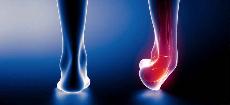 Lateral Ankle Sprain (LAS)