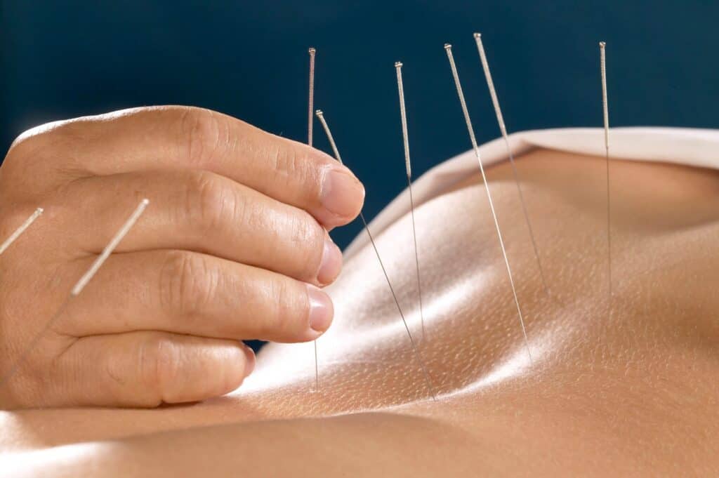acupuncture fibroids treatment