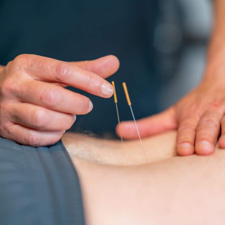 Dry Needling